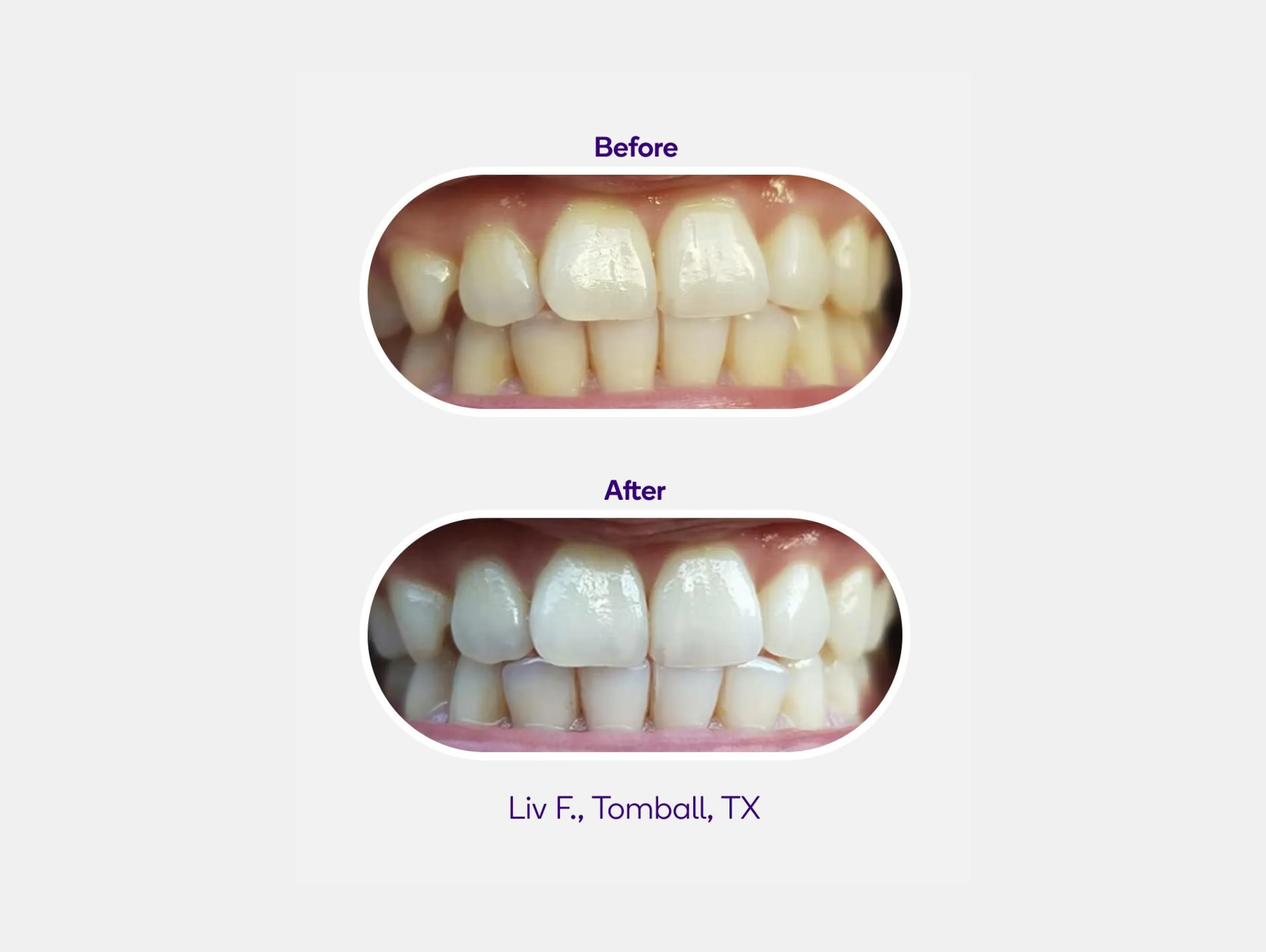 Non-Slip Whitening Strips - Image 5