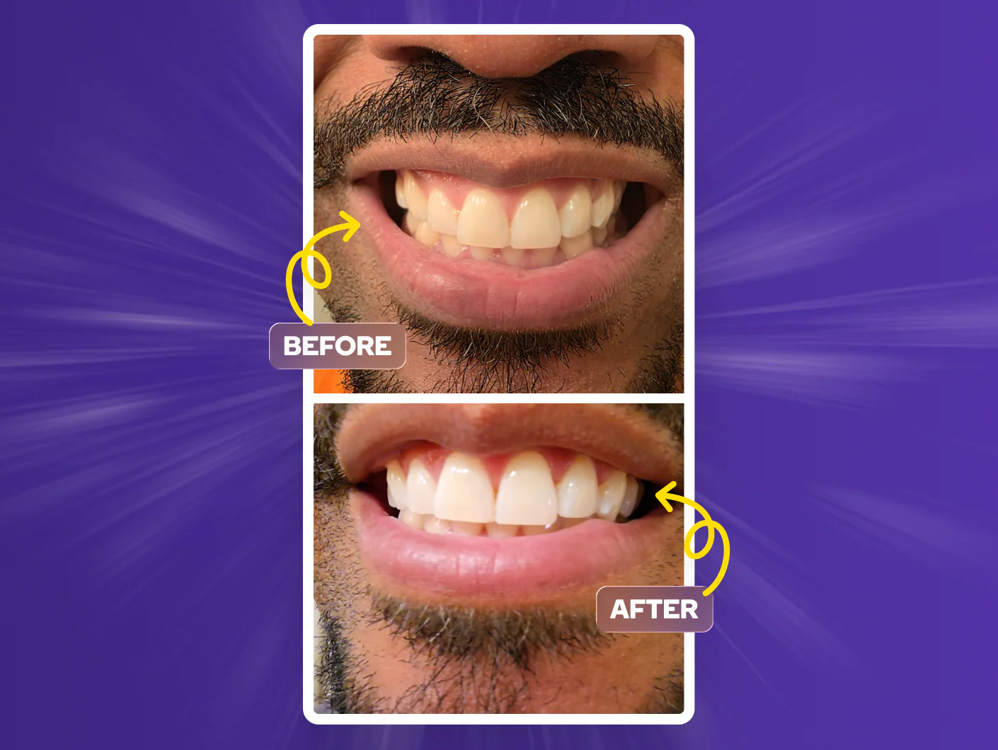 Prefilled Whitening Trays - Image 7